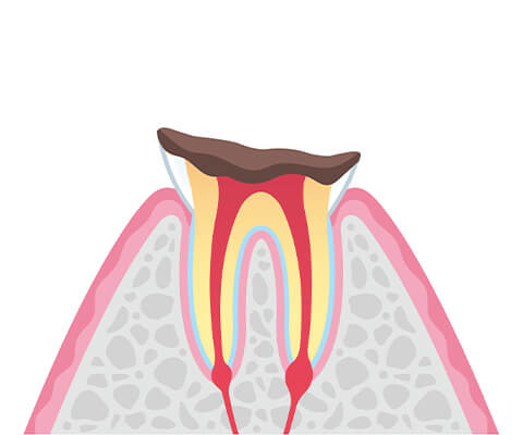 歯の根の虫歯